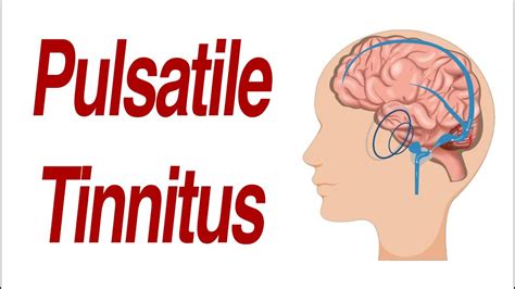 <b>Tinnitus</b> is a common symptom of TMJ, which is a condition caused by inflammation or irritation of the muscles and joints. . Pulsatile tinnitus aneurysm symptoms